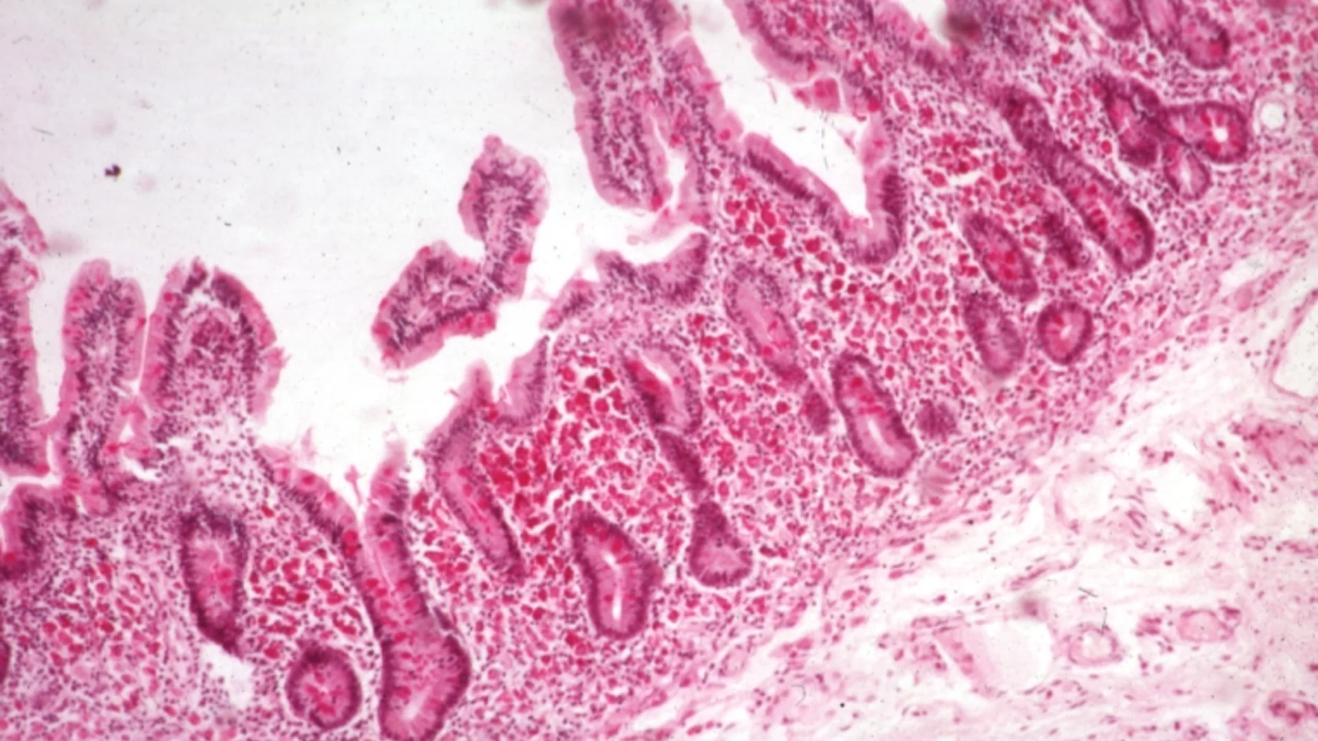 Primary Malabsorbation